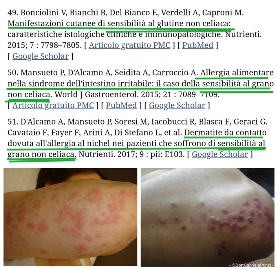 SENSIBILITA' AL GLUTINE NON CELIACA E "DERMATITE ERPETIFORME"