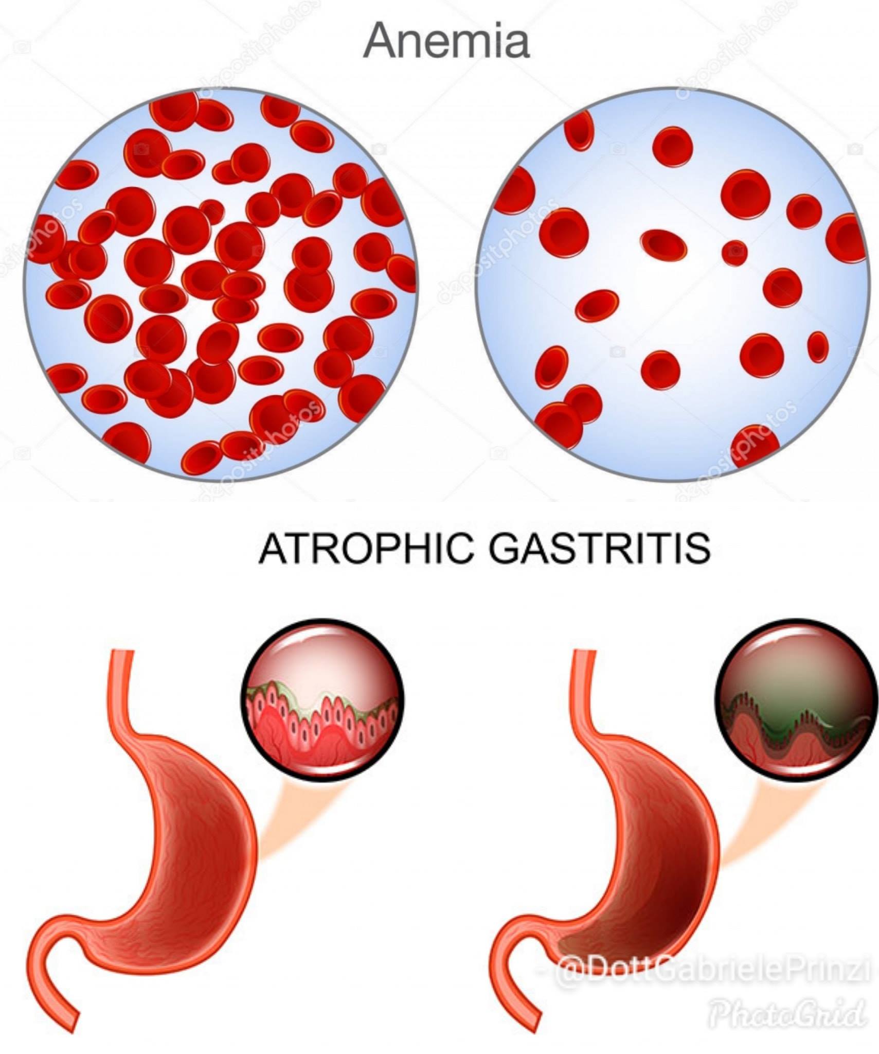 CARENZA DI FERRO, GASTRITE ATROFICA ED ANEMIA. LEZIONI (purtroppo) DIMENTICATE ...