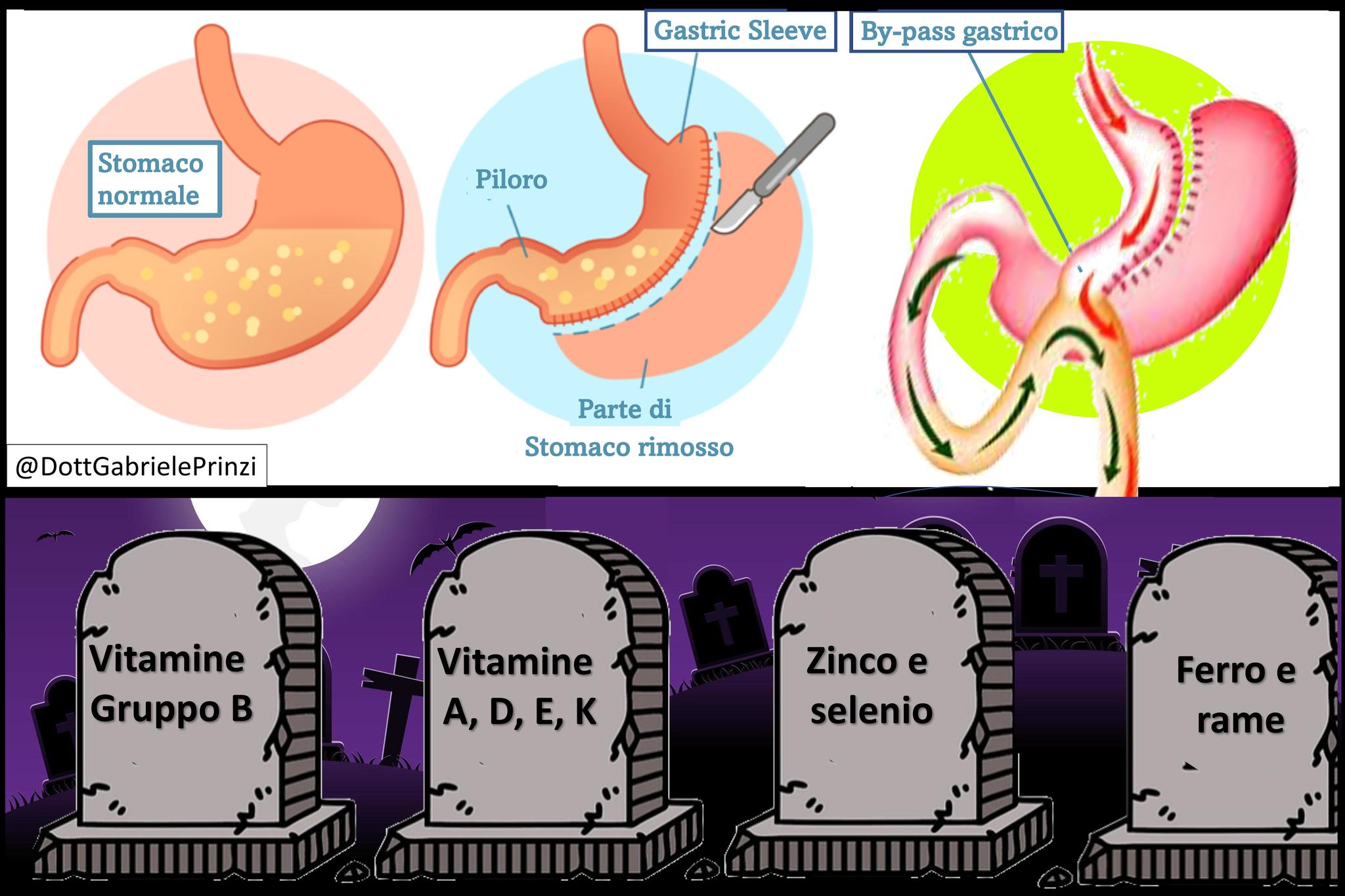 A CHI E' STATO SOTTOPOSTO A CHIRURGIA BARIATRICA: TI HANNO PARLATO DEGLI EFFETTI SULLE VITAMINE E LA SALUTE MENTALE?