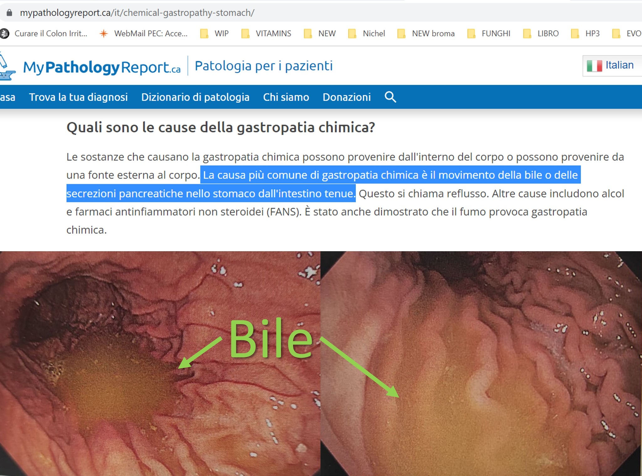 PRIMO DOGMA DELLA GASTROENTEROLOGIA:   NON ESISTE IL REFLUSSO BILIARE